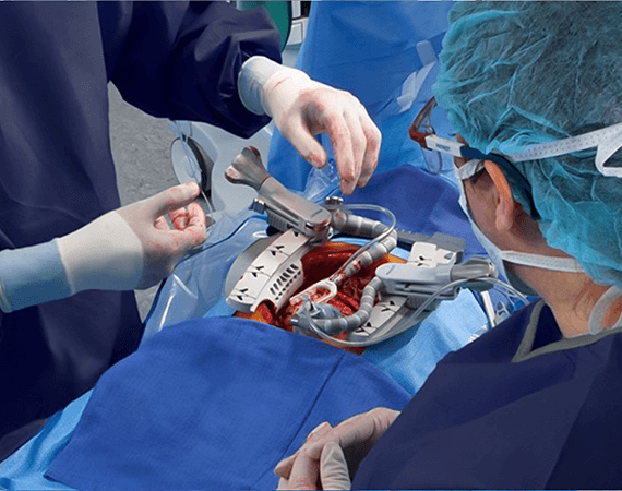 CABG Surgery